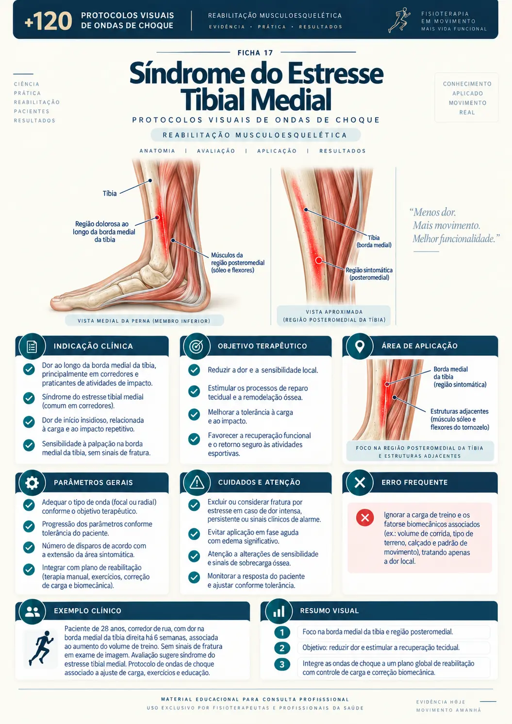 Síndrome do Estresse Tibial Medial