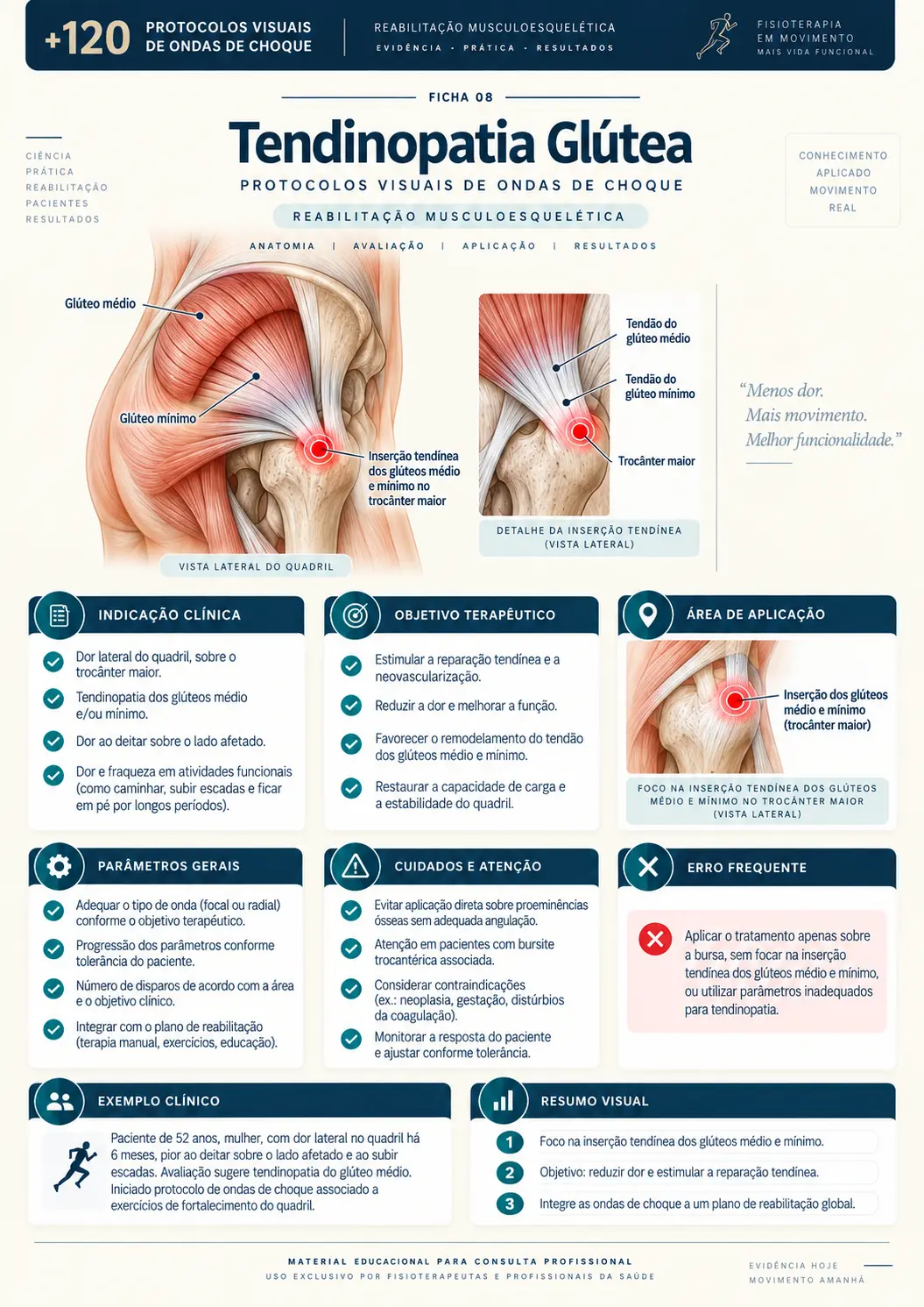 Tendinopatia Glútea